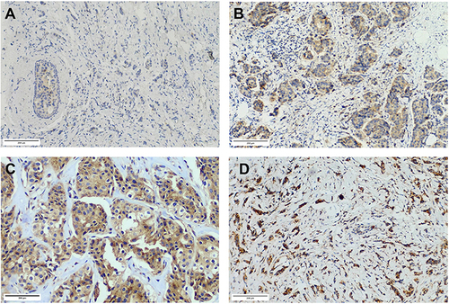 Figure 3 Different TRIM58 immunochemistry staining. (A). Weak TRIM58 expression with a staining score of 1 (≤ 6). (B). Weak TRIM58 expression with a staining score of 6 (≤ 6). (C). Strong TRIM58 expression with a staining score of 8 (> 6). (D). Strong TRIM58 expression with a staining score of 12 (> 6).