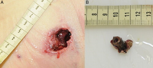 Figure 1. Photograph showing a projectile that had impacted intermediate obstacles before skin entrance (B), and the resulting irregularly-shaped skin wound (A).