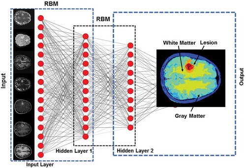 Figure 5. Illustration of a Deep Belief Network (DBN) with two hidden layers for segmentation of an example multiparametric MRI brain dataset. Each layer is pre-trained in an unsupervised fashion using Restricted Boltzmann Machines (RBMs) utilizing the outputs from the previous layer. The output from DBN segmentation on the example dataset is shown in the output layer.