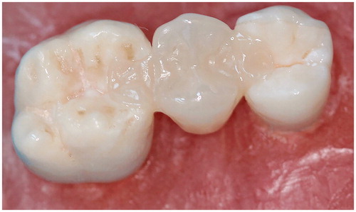 Figure 2. Test specimen for inlay retained fixed partial denture.