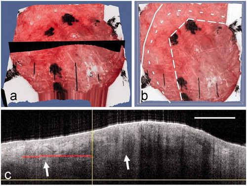 Figure 3. (a) A surface view of the 3D OCT-dermoscopy dataset from a mixed nodular/infiltrative BCC. A clinician-selected plane straddling the clinical border is shown in black. (b) A different view of the 3D dataset showing segments of the pre-surgical border, the OCT-defined border and the final surgical defect as large-dashed, small-dashed and solid lines, respectively. (c) The OCT image from the clinician-selected plane showing ovoid structures interpreted as BCC cell nests (arrowed). The vertical line represents the pre-surgical border and the horizontal line the extent of infiltration of BCC assessed by a dermatologist. The OCT image scale bar corresponds to 1 mm.