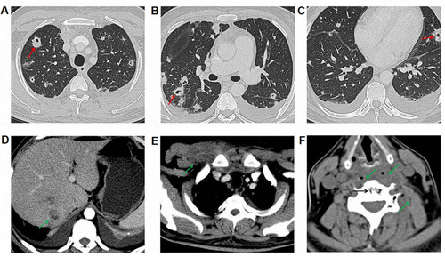 Figure 1 Enhanced computerized tomography (CT) of the implicated organs at admission. (A) Superior field of the lung; red arrow indicates multiple pulmonary nodules, partial liquefaction and necrosis; (B) Middle field of the lung; (C) Inferior field of the lung; (D) The right-posterior lobe of the liver; green arrow indicates abscess; (E) Right anterior superior chest wall; green arrow indicates abscess; (F) 5th cervical vertebra bone destruction with prevertebral abscesses; black arrow indicates bone destruction in the 5th cervical vertebra, and green arrow indicates prevertebral abscesses.