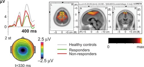 Figure 2 The independent component no-go early is decreased in the responder (RE) group. Left: the independent component for the group of REs (green) and non-REs (red) in comparison with the group of healthy controls (grey). X-axis – time after the onset of the second stimulus in ms. Y-axis – amplitude of the component back-projected and measured at Cz. Right: the standardized low-resolution brain electromagnetic tomography (sLORETA) image of the cortical generators of the component. The scale is shown below. Bottom: the map of the difference REs minus non-REs. The scale is shown on the right.