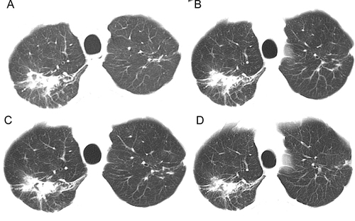 Figure 3 Changes in the images of the upper lobe of the right lung shown on chest CT before and after pulmonary Aspergillus infection and during antifungal procedures. Image (A) shows a chest CT image before the Aspergillus infection. Images (B–D) are chest CT images after the Aspergillus infection, representing images after 2, 4, and 5 months of antifungal therapy. Images (A–D) all show irregular nodular shadows in the upper lobe of the right lung with cavity formation. Images (A and B) show lesions of approximately similar extent but with increased density and fungus ball formation. Images (B–D) all show fungus ball formation but gradual resorption of the lesion.