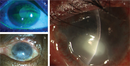 Figure 4. The corneal changes showing superficial punctate keratitis (a), corneal opacification, and vascularization (b), sterile corneal melt (c).
