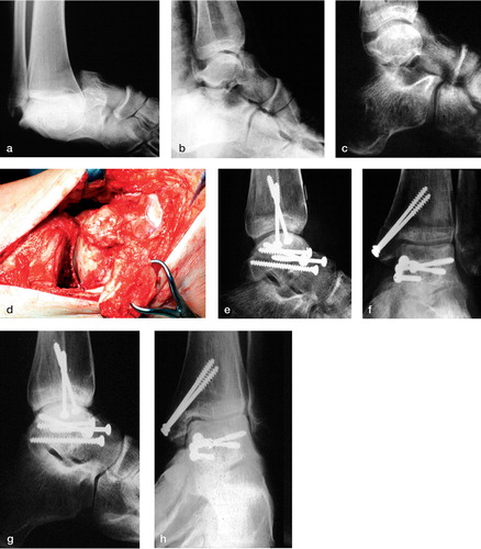 Figure 2. Reconstruction of a talar malunion with partial AVN (type III deformity). A 21-year-old man presented with painful malfunction of the foot 6 months after non-operative treatment of a displaced fracture of the talar neck (Hawkins Type III) with dislocation at the ankle and subtalar joints (a). Initially, closed reduction was attempted and a below-the-knee cast was applied (b). The lateral radiographs after 6 months showed a considerable step-off in the articular surface, with severe ankle impingement. Reduced radiolucency of the superior aspect of the talar dome indicated partial avascular necrosis (c). Intraoperative aspect of the malunited talus after osteotomy of the medial malleolus (d). Anatomical reconstruction of the ankle and subtalar joints was achieved with a talar neck osteotomy through the former fracture, reorientation of the talar body and screw fixation (e, f).3 years after reconstruction, the patient had an excellent clinical result. No arthrotic changes and no progression of the AVN could be seen (g, h).