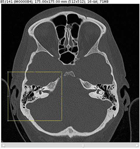 Figure 3. Representative individual CT slice with cropping frame for limitation of the data volume. The incus can be clearly identified as a distinct object.