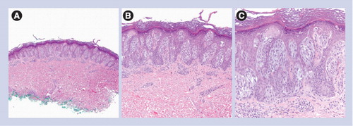 Figure 1. Conventional Spitz nevus.(A) Low power circumscription and symmetry with epidermal hyperplasia (40×). (B) Nests of epithelioid melanocytes are arranged vertically to the skin surface with ‘raining down’ appearance (100×). (C) Higher magnification shows epithelioid melanocytes, Kamino body and occasional pagetoid scattering (200×).