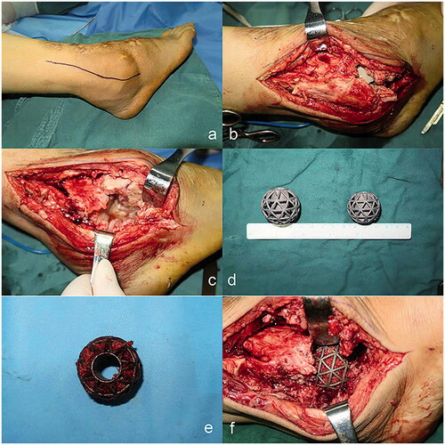 Figure 4. Surgical process in right ankle of patient with CN (a–c, e, f). Initially two sizes, diameter 3 and 3.4 cm respectively, of metal implant (d) produced by manufacture. In practice, the bigger one was implanted in the anatomic place of talus.