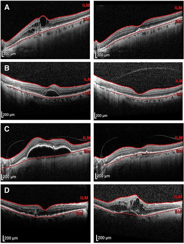 Figure 2 Representative OCT images of (A) intraretinal fluid, (B) subretinal fluid, and (C) serous pigment epithelial detachment resolution after brolucizumab treatment. (D) Paradoxical worsening of retinal fluid was occasionally observed following treatment with brolucizumab.