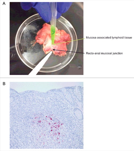 FIGURE 3. Isolation and immunohistochemical detection of PrPD from RAMALT sample. (A) Dissection of recto-anal mucosal (RA) junction to isolate mucosa-associated lymphoid tissue (MALT) for RAMALT sample. (B) Immunohistochemistry of RAMALT from elk (Cervus elaphus nelsoni). Note the proteinase-resistant prion staining (red chromogen) distribution within the lymphoid follicle located in the lamina propria. Staining was done using a mouse monoclonal antibody F99/97.6.1 against epitopes at residues 220–225 of prion protein and developed with streptavidin-alkaline phosphatase method. The slides were further counterstained with hematoxylin (blue stain).