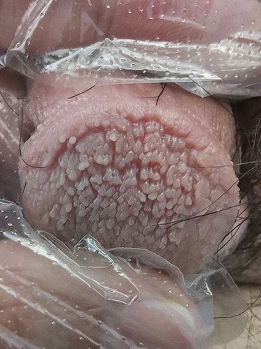 Figure 1 Physical examination revealed dense monomorphic soft flesh-colored filiform papules over the entire glans with a “cobblestone” appearance.