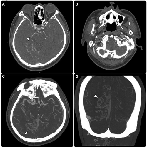 Figure 1 (A and B) Enhanced angiographic CT examination in and (C and D) maximum intensity projection technique showed a complex tangle of dilated and tortuous vessels of the right-sided temporoparietooccipital regions and posterior condylar area (arrowheads).