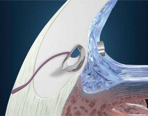 Figure 2 iStent® implantation location.