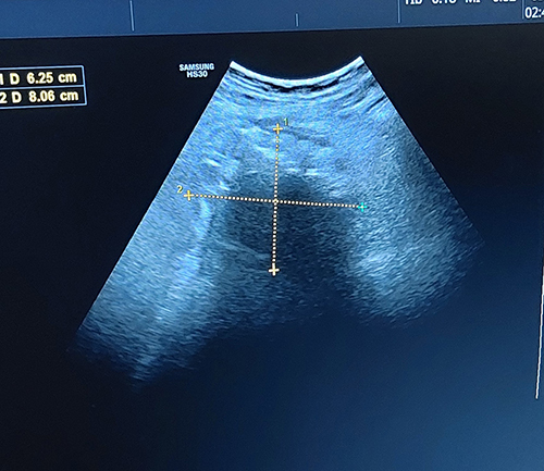 Figure 3 Abdominal ultrasound showed a 7×7.7cm large and ill-defined homogeneously shadowing left lower abdominal mass lesion with increased adjacent mesenteric fat reflectivity.