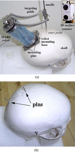 Figure 1. System concept: (a) The MARS robot mounted on the skull. (b) Skull-mounted pins. (c) The robot mounting base. [colour version available online.]