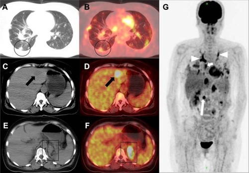 Figure 2 The 18F-FDG PET/CT scans of the patient.