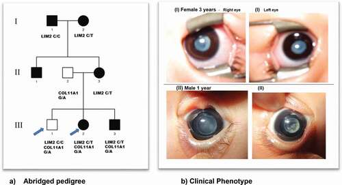 Figure 1. (a) Abridged pedigree with lamellar/sutural congenital cataract. Squares and circles symbolize males and females, respectively. Open and filled symbols indicate unaffected and affected individuals, respectively. The arrows indicate the family members who participated in the WES analysis and were sequenced to show segregation; (b) (I) III:2 depicts bilateral lamellar cataract and in (II) III-3 with sutural cataract in left eye and lamellar cataract in the right eye.