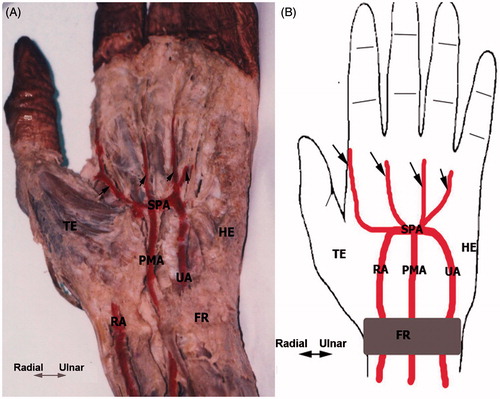 Figure 1. Ventral aspect of the distal third of the forearm and hand (after dissecting out from the cadaver and the arteries are colored red). (A) Cadaveric hand exhibiting the radio-medio-ulnar type of SPA. (B) Patterns of PMA contribution to SPA. Arrows indicate palmar digital arteries. FR, flexor retinaculum; HE, hypothenar eminence; TE, thenar eminence.