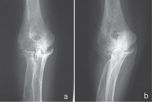 Figure 3. a. A right elbow 6 years after the onset of rheumatoid arthritis; Larsen grade 4. This patient complained of severe pain, swelling, and disability in activities of daily living (ADL), and motion was from 30° to 105°. The preoperative MEPS was 50 points. b. 11 years after surgery; Larsen grade 4. The patient had experienced relief of the pain with no swelling and no disability in ADL. The MEPS was 95 points.