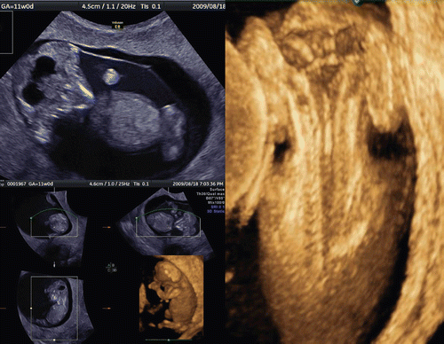 Figure 22.  Acrania with cervical spina bifida (craniorachischisis) at 11 weeks of gestation. Left upper; 2D image. Note the amniotic fluid is more turbid than chorio-amniotic cavity due to floating nerve tissue from destroyed brain. Left lower; Three orthogonal view and reconstructed image. Right; 3D reconstructed image of cerebrospinal region. This fetus is complicated with acrania and cervical spina bifida, so-called craniorachischisis.