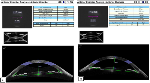 Figure 5 AS-OCT on the RE and LE. The anterior chamber angles in both eyes exhibited similarity, with both being shallow. Pink arrows in the ACT imaging showed the plane where the calculations were taken.