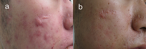 Figure 1 Comparison of the cases in combination therapy before and after treatment in Pt 4. (a) Lesion before treatment. (b) Lesion after three ALA-PDT combined with one intralesional injection treatment.