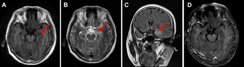 Figure 2 Images from the magnetic resonance imaging after admission.