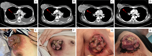 Figure 4 Axial CT of the breast (red arrow) before neoadjuvant therapy (A). The right breast mass decreased from 8.5×6.7 cm to 4.9×5.6 cm (red arrow) after two-cycle of R-CHOP (B), rapidly increased to 7.4×8.7 cm (red arrow) after three-cycle of R-CHOP (C), and decreased to 3.9×3.7 cm (red arrow) after R-TP (D). The corresponding photos of the right breast mass before neoadjuvant therapy (E), after two-cycle of R-CHOP (F), after three-cycle of R-CHOP (G), and after R-TP (H).