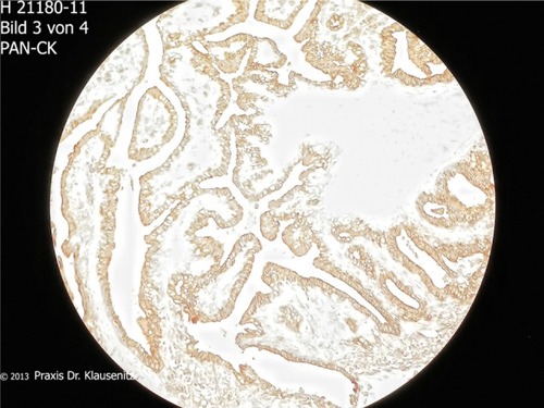 Figure 5 Pan-cytokeratin positive staining in immunocytochemistry.