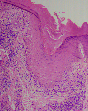 Figure 10 Histopathology of scalp discoid lupus erythematosus shows periinfundibular pigment incontinence corresponding to the perifollicular blue-gray dots (H & E, X100).