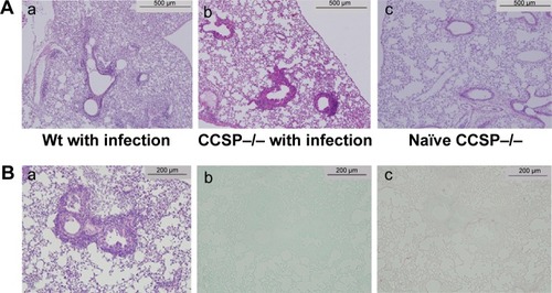 Figure 2 Lung histology of chronic Pseudomonas aeruginosa infection.