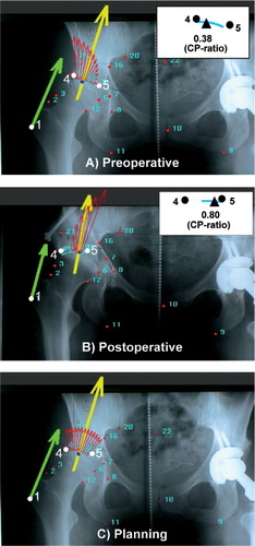 Figure 4. An example of a case with high pressure gradient. The figures are arranged as in Figure 3. In this example, 8.5° lateral rotation of the acetabulum during biomechanical preoperative planning (C) resulted in an even pressure distribution over the whole potential contact area. However, the postoperative analysis (B) showed significant differences compared to the biomechanical planning results, indicating nonoptimal surgical outcome in terms of joint contact pressure. Postoperatively, we observed a high peak pressure and remarkably smaller weight-bearing area. The CP-ratio was 0.8, and the peak contact pressure was shifted toward the medial edge (point 5). F-AC angle changed from 19° preoperatively to −7° postoperatively, and the F-CE angle changed from 15° preoperatively to 50° postoperatively.