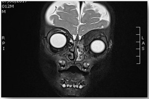 Figure 4 T2 weighted image, coronal view of head and orbit, showing extra-conal isointense soft tissue mass of superomedial aspect of left orbit causing inferolateral displacement of left globe and medial orbital wall erosion with periosteal reaction, and opacification of left ethmoid and both maxillary sinuses. Surrounding fat planes are preserved.