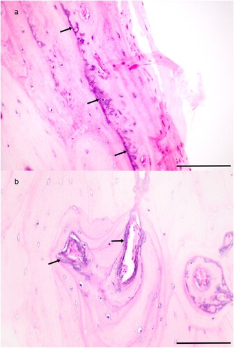 Figure 3. Photomicrographs of sections of bone from a lumbar vertebra of a 13-year-old female Toggenburg goat with soft tissue mineralisation showing abnormal basophilic floccular matrix lining a) bone lamellae and b) osteons (H&E; bar 100 μm).