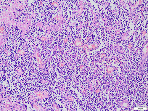 Figure 6 Diffused infiltration of a large number of lymphocytes and plasma cells accompanied by small vascular proliferation.
