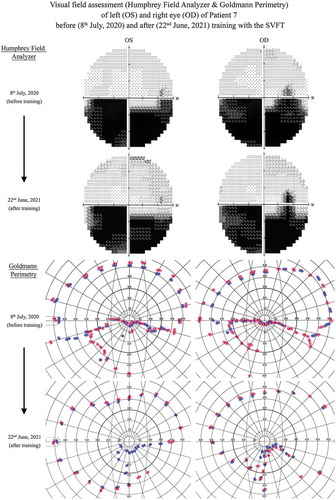 Figure 5. Illustration of visual field test with Humphrey Field Analyzer and Goldmann Perimetry before and after training with the “Salzburg Visual Field Trainer” (SVFT). While the results of the Humphrey Field Analyzer do not suggest any significant changes in the visual field of Patient 7, the results of Goldmann Perimetry indicate noticeable improvements. Particularly in areas on the lower left and in lower areas of the inner 10° of visual angle, apparent improvements can be observed