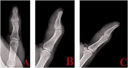 Figure 4. Anteroposterior (A), lateral (B), and oblique (C) views post excision of synostosis.