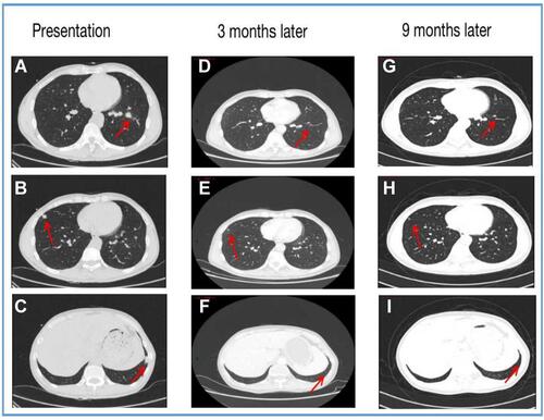 Figure 3 Chest computed tomography scans demonstrating numerous metastatic (red arrows), (A-C) at diagnosis, (D-F) following 3 months of alectinib treatment, and (G-I) following 9 months of alectinib.