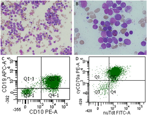 Image 1. Bone marrow aspirate and flow cytometry. Bone marrow aspirate at diagnosis demonstrates a markedly hypercellular marrow with a diffuse infiltrate by pleomorphic blasts with open chromatin and inconspicuous nucleoli representing 75% of nucleated cells. There is an associated marked reduction in trilineage hematopoiesis. (A) May Grunwald Giemsa (MGG) stain ×40 magnification. (B) MGG stain ×100 magnification. Flow Cytometry plots from bone marrow aspirate at diagnosis demonstrate a lymphoblast immunophenotype with (C) CD19dim/CD10 co-expression. (D) cyCD79a/nuTdt co-expression.