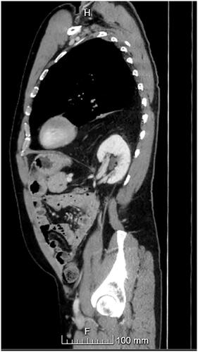 Figure 1. A sagittal view of a left-sided Bochdalek hernia from a CT scan. Omental fat as well as the left kidney can be seen herniating through the posterolateral hernia defect in the diaphragm.