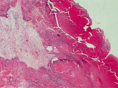 Figure 9. On low power, pushing border and trichilemmal keratinization. H&E; original magnification, ×40.