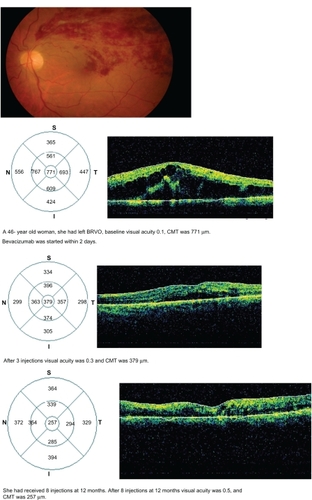Figure 1 The result of bevacizumab therapy in a patient with macular edema secondary to branch retinal vein occlusion (BRVO). A 46-year-old woman had left BRVO, baseline visual acuity of 0.1, and central macular thickness (CMT) of 771 μm. Bevacizumab was started within 2 days. After three injections, visual acuity was 0.3 and CMT was 379. She had received eight injections at 12 months. After eight injections at 12 months, her visual acuity was 0.5 and CMT was 257 μm.