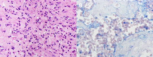 Figure 3 Pathological staining of knee joint effusion and inflammatory tissue. (A) Inflammatory cell infiltration was seen by HE staining. (B) Acid-fast staining was negative.