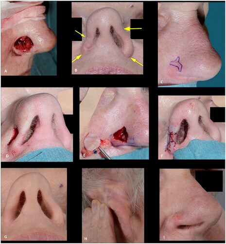 Figure 6. (A) Resection of basal cell carcinoma at the right alar rim, which was left to heal by secondary intention. (B) Shrinkage and collapse of the nostril led to nasal obstruction, which was evident at four months follow up. Note the shortened height of the ala in comparison to the contralateral ala (yellow arrows). (C–F) Revision surgery with a composite graft from the posterior surface of the ear was performed nine months after the defect was left to heal secondarily, successfully alleviating the nasal obstruction. Note the cautious cautery to the wound bed and the wide cartilage wings needed to stabilize the alar I. (G) An excellent functional outcome was observed three months later. (H,I) At twenty-two months follow up the functional outcome was still excellent, and the discoloration had subsided and donor site had healed well. The outcome was rated as good.