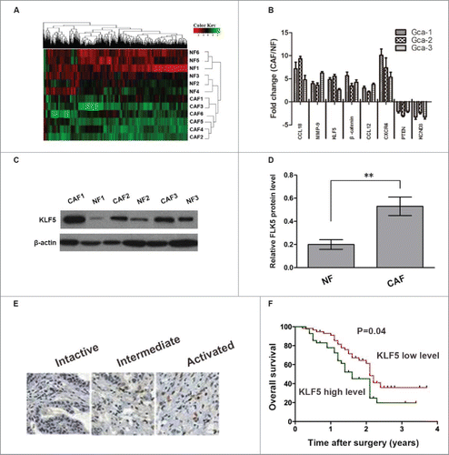Figure 1. KLF5 expression in gastric cancer associated fibroblasts and gastric cancer stromal tissues. (A) The dysregulated genes were analyzed by cDNA array used 6 paired CAFs and NFs obtained from patients with gastric cancer. (B) Eight selected genes were analyzed by qRT-PCR in CAFs and NFs derived from gastric cancer patients. Data are shown as fold changes between CAFs and NFs. (C, D) The expression of KLF5 protein in 3 paired CAFs and NFs were measured by Western-blot assay. (E, F) Representative images of KLF5 immunostaining assay in gastric cancer stromal tissues. Kaplan-Meier analysis showed that high level of KLF5 expression in stroma is associated with decreased overall survival (P = 0.04). Data are representative of three independent experiments. *P < 0.05 by t test, **P < 0.01 by t test.