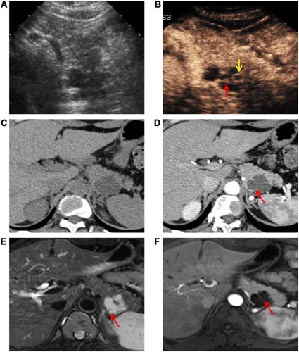 Figure 2 A serous cystadenoma diagnosed via pathology in a 42-year-old woman without symptoms. (A) A US image shows an anechoic-hypoechoic lesion with an irregular shape 3.8 cm in diameter in the pancreatic tail. (B) CEUS image clearly depicts the lobulated shape with a thin septum (red arrow) and a small daughter cyst (yellow arrow). (C) Plain CT scan revealed a watery density mass with an unclear internal structure. (D) Contrast-enhanced CT demonstrates lobulated morphology and septum (red arrow). (E) T2-weighted MRI shows a thin intralesional septum (red arrow). (F) Enhanced MRI reveals the septum (red arrow).