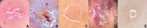 Figure 3 Dermoscopic images of scale morphology: (A) diffuse, (B) central, (C) peripheral (D) patchy, and (E) circular (x10 original magnification).