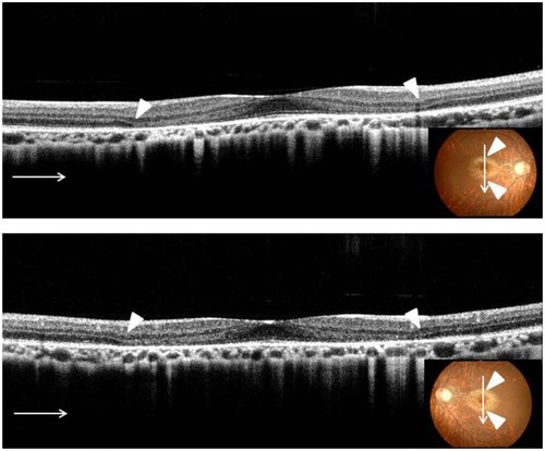 Figure 3 Right and left vertical optical coherence tomography scan had the same findings as horizontal optical coherence tomography scans.