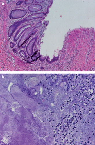 Figure 2. a) HE staining of the tumor showing the margin of the ulcer showing no remaining cancer tissue (magnification 800×). b) HE staining of the regressive tissue showing actinomyces granulomas and inflammatory cell invasion (magnification 800×).